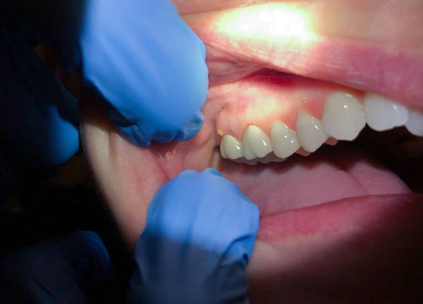 Best Emergency Care for Gum Disease in Liberty, NC